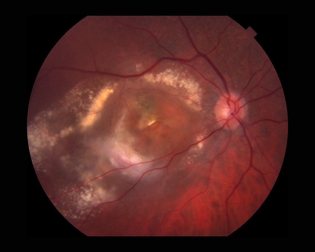 Wet Age-Related Macular Degeneration