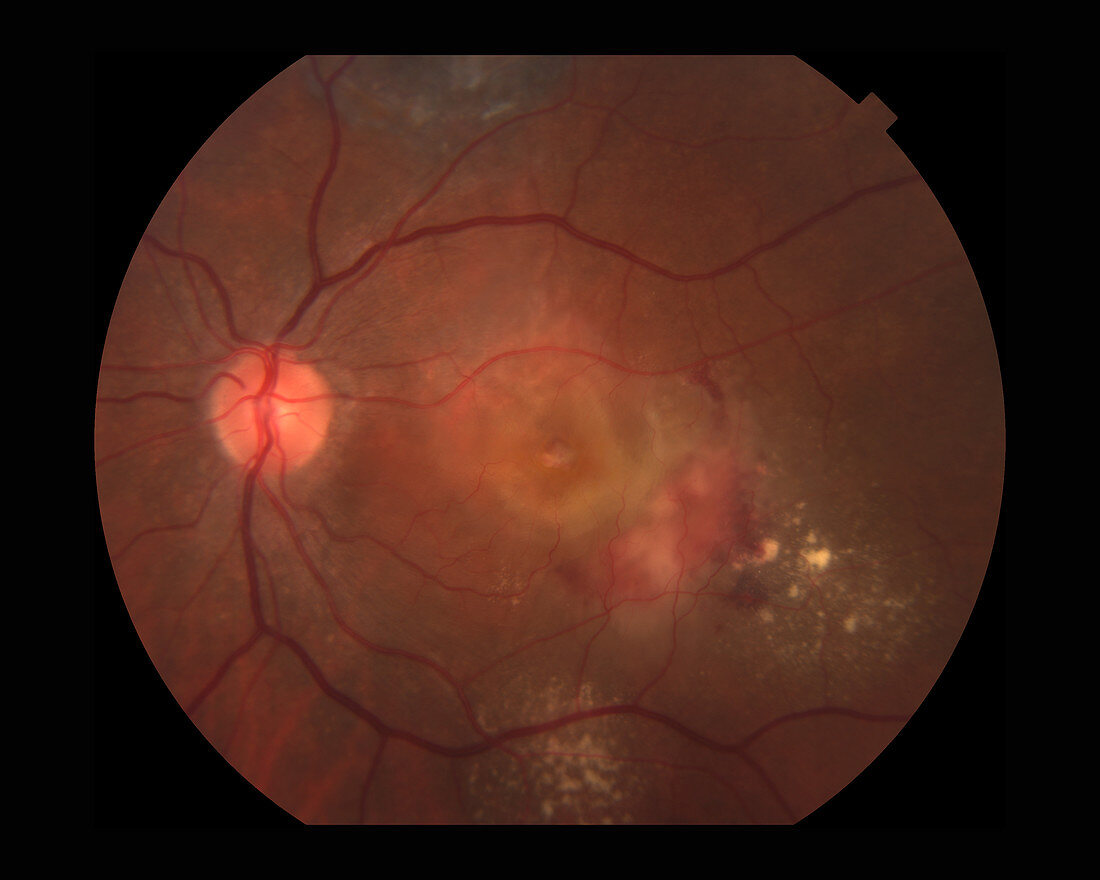 Wet Age-Related Macular Degeneration