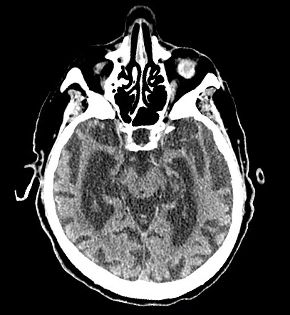 CT of Alzheimer Disease