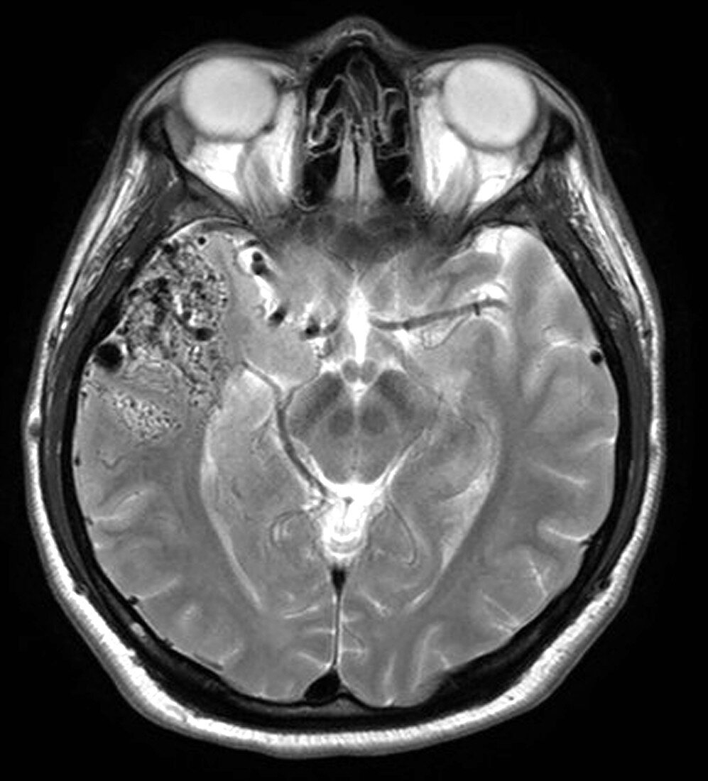 Temporal Lobe AVM on MRI