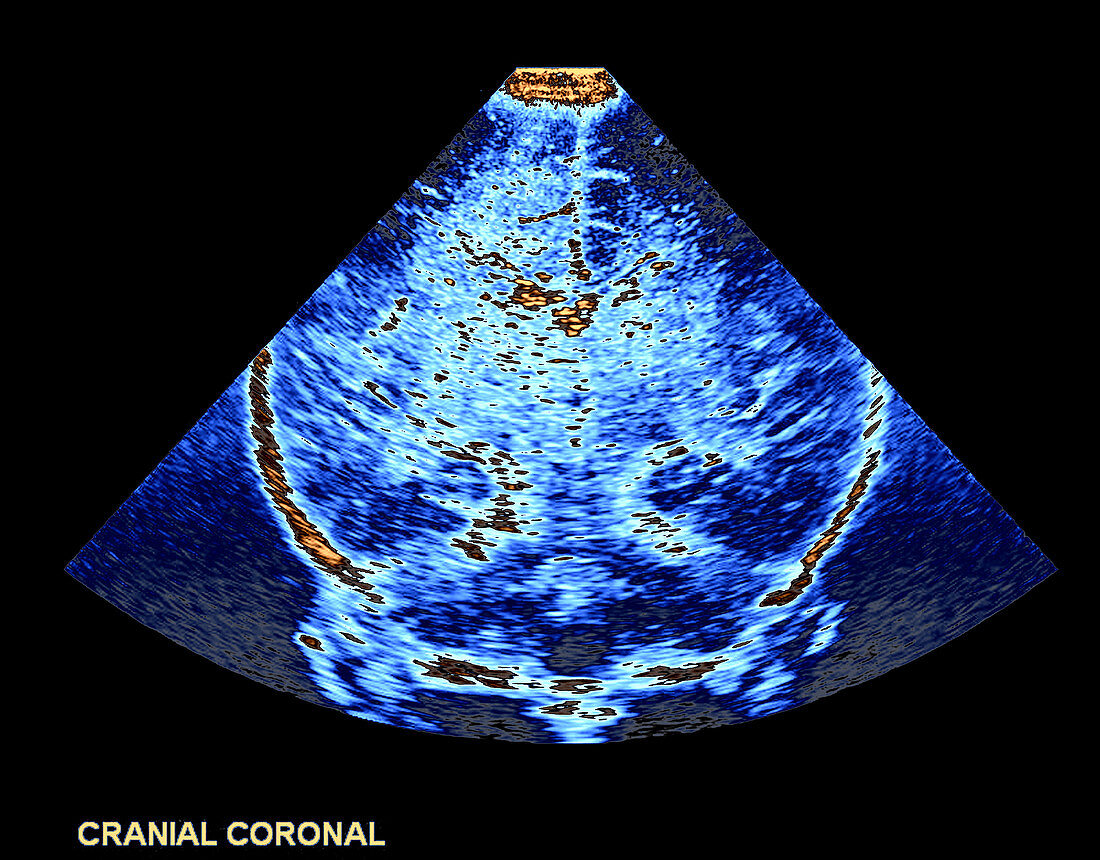 Enhanced Neonatal Transcranial Ultrasound