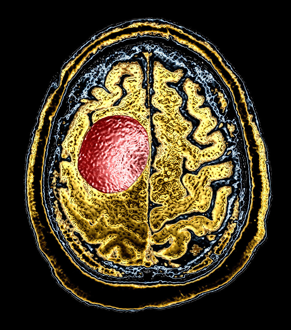 Enhanced Large Meningioma on MRI