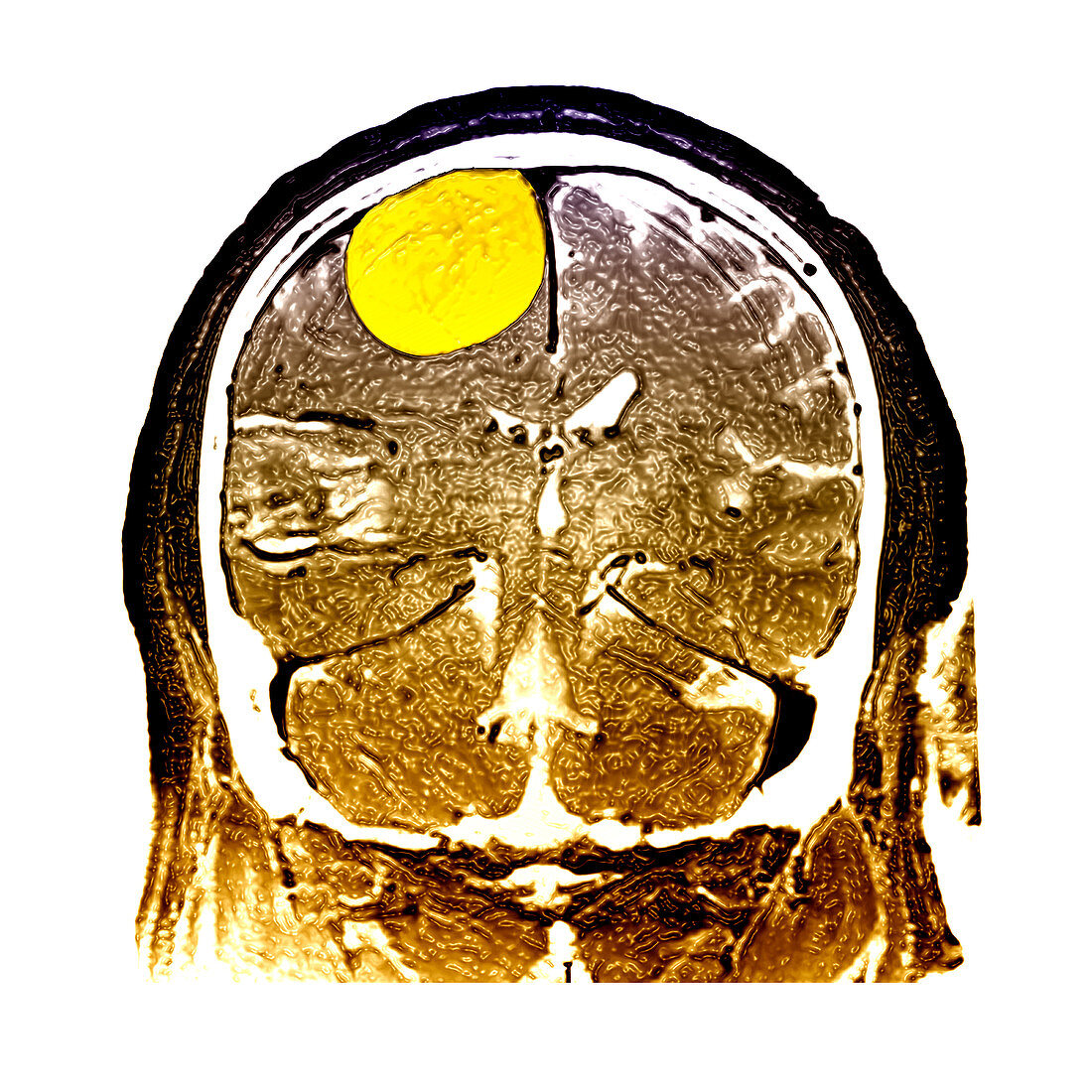 Enhanced Large Meningioma on MRI