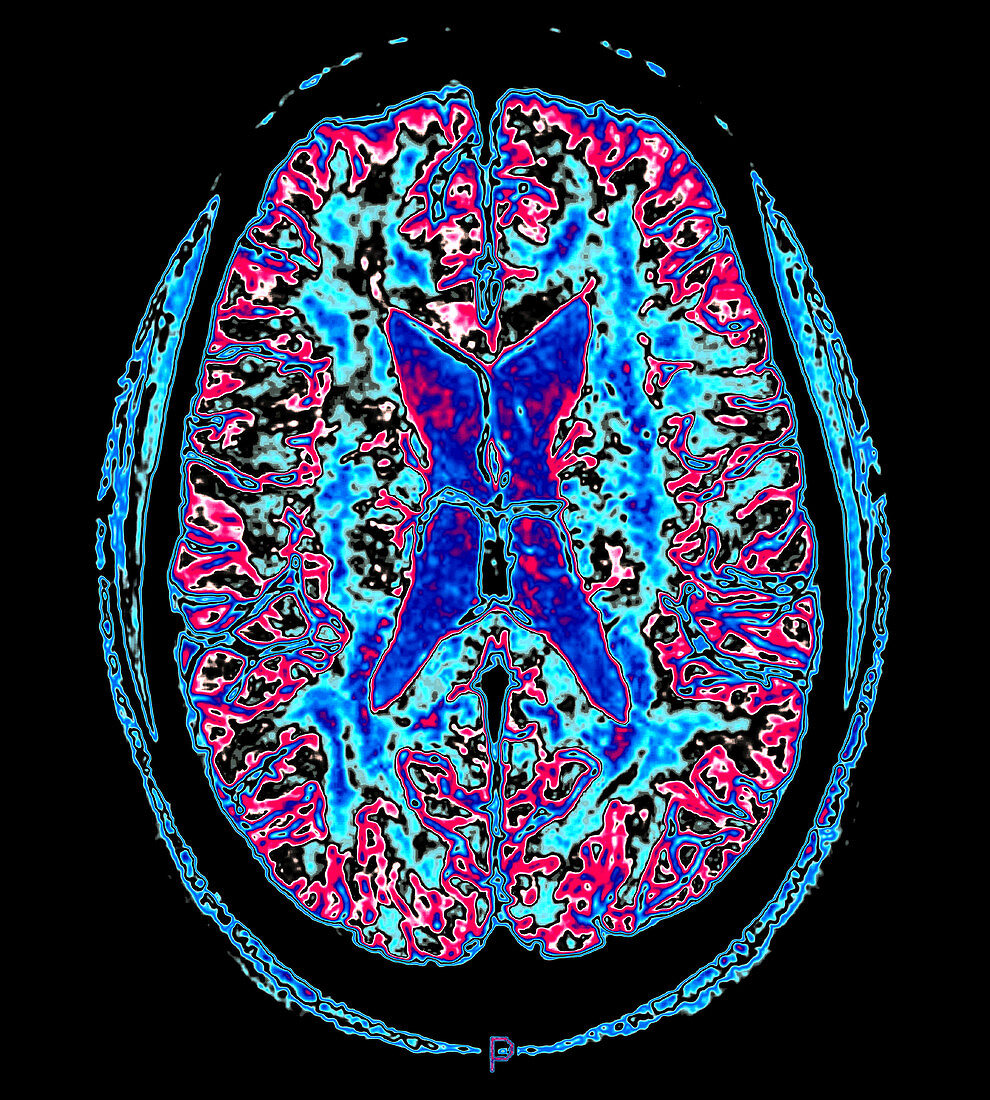Enhanced MR Image of Brain