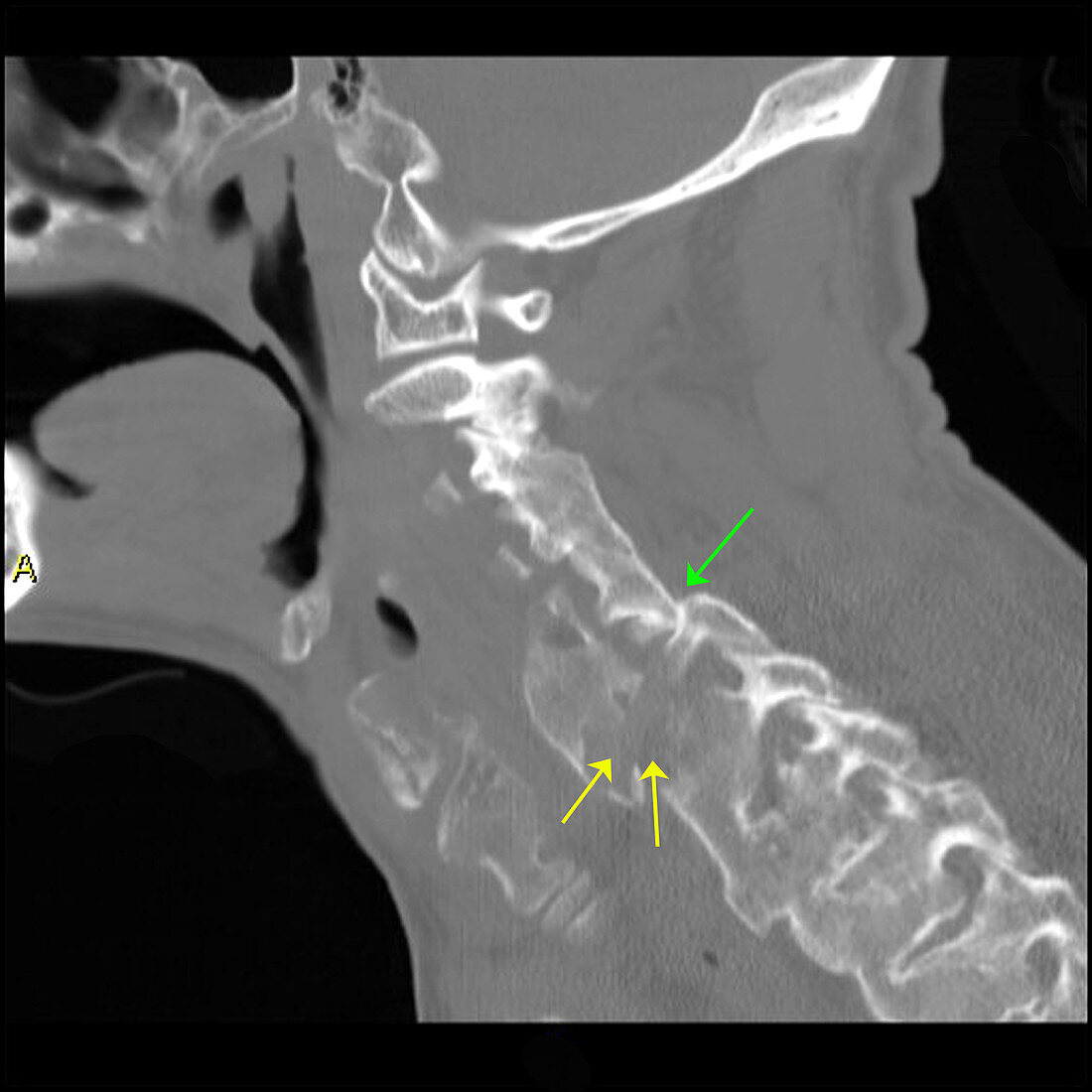 Chance Fracture and DISH