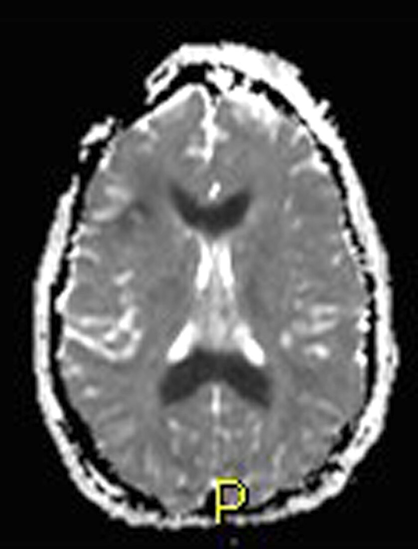 Severe Traumatic Brain Injury,MRI