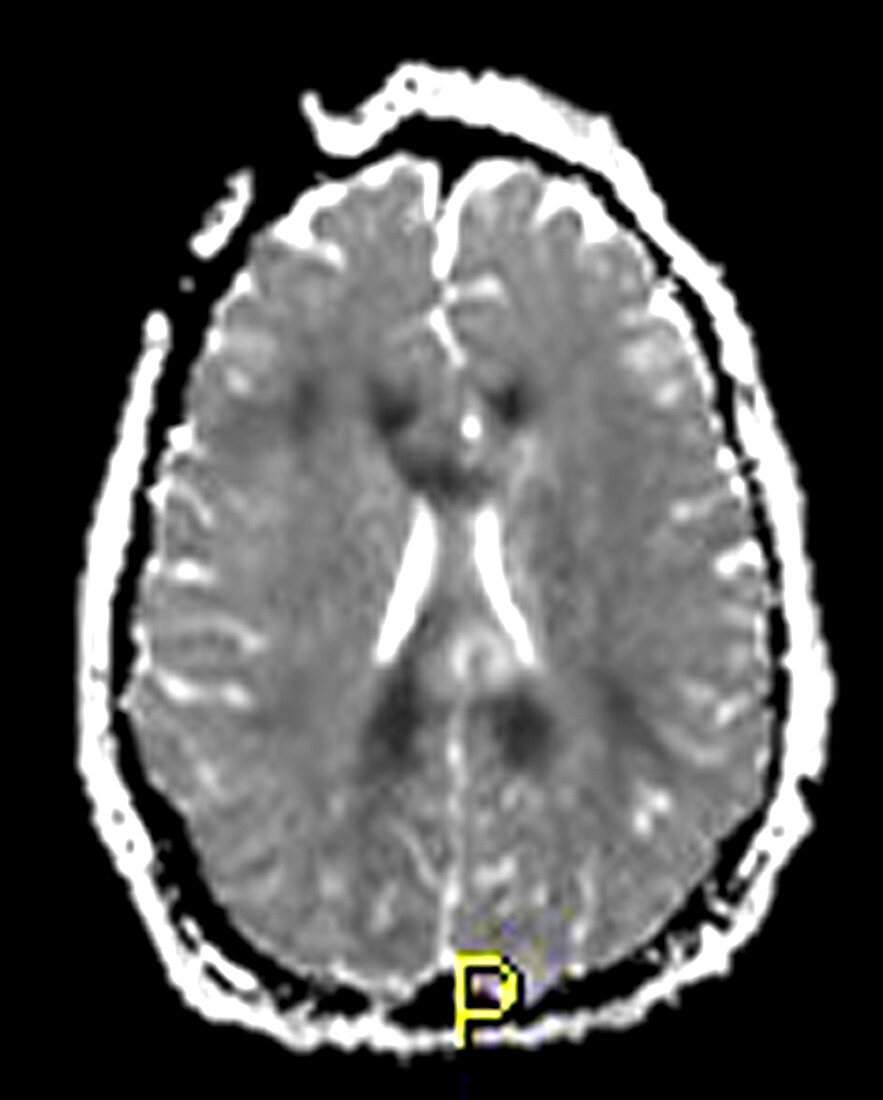 Severe Traumatic Brain Injury,MRI