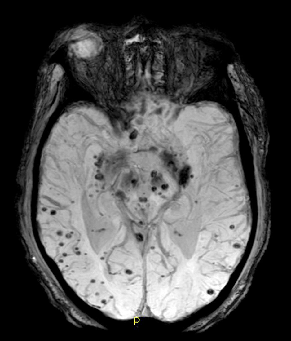 Intracerebral Haemorrhages,MRI