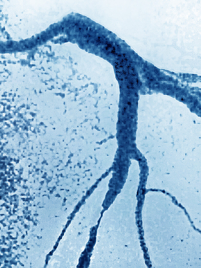 Myocardial Infarction,Angiogram