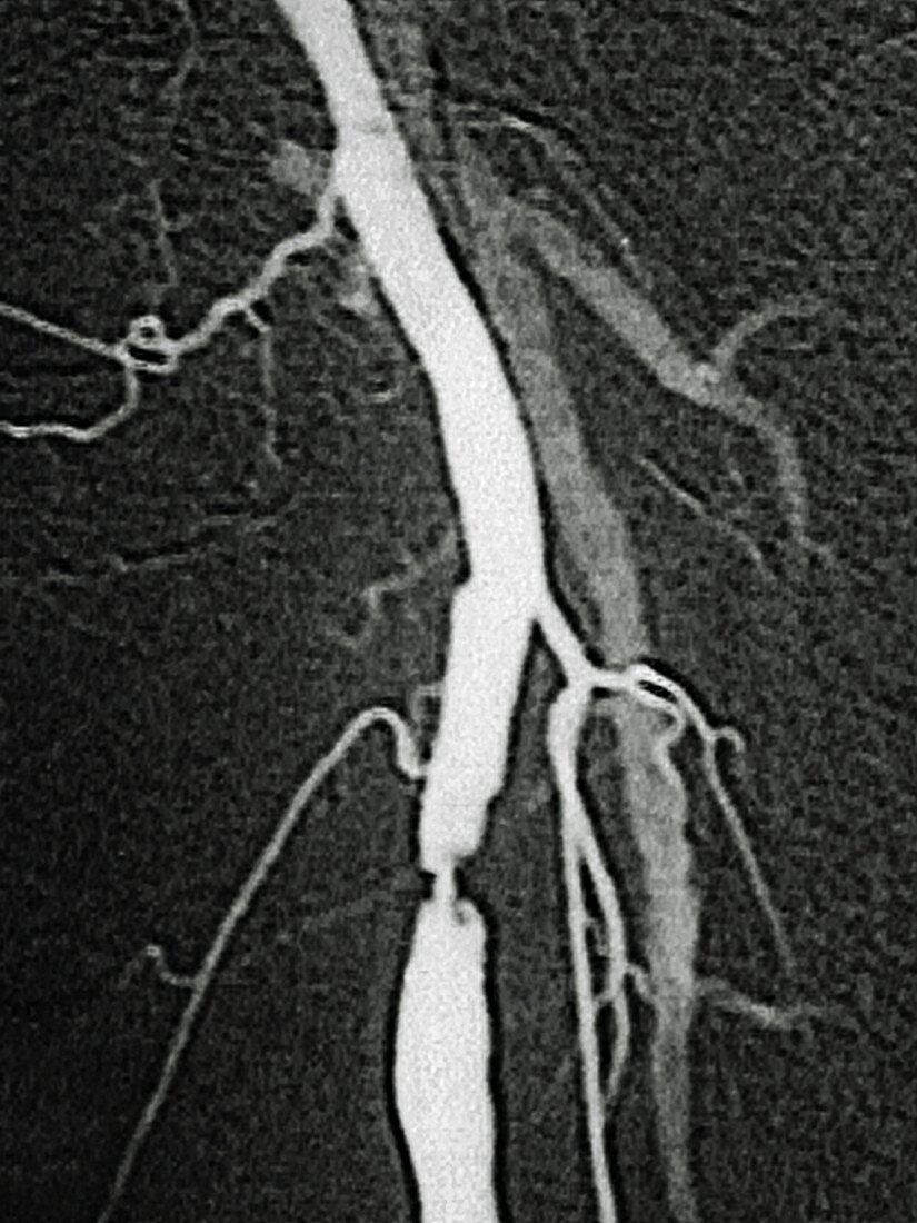 Stenosis on Iliac Artery