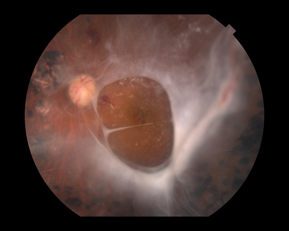 Proliferative Diabetic Retinopathy