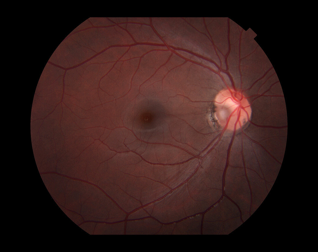 Congenital Optic Nerve Pit