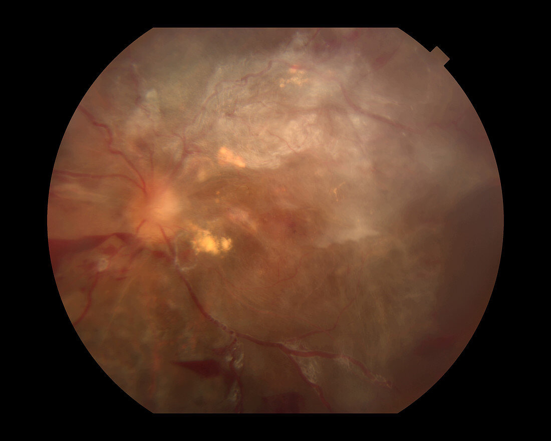 Proliferative Diabetic Retinopathy