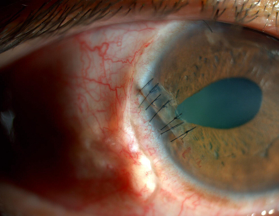 Ocular Puncture Wound