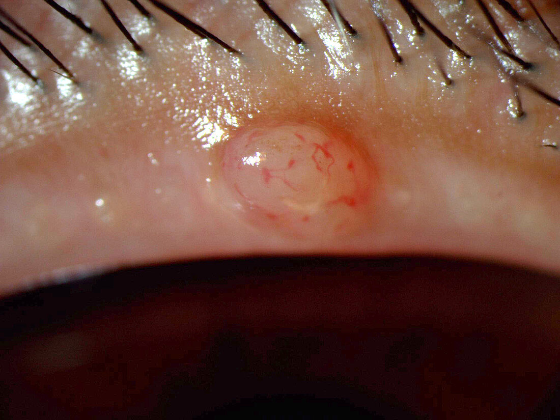 Conjunctival Cyst