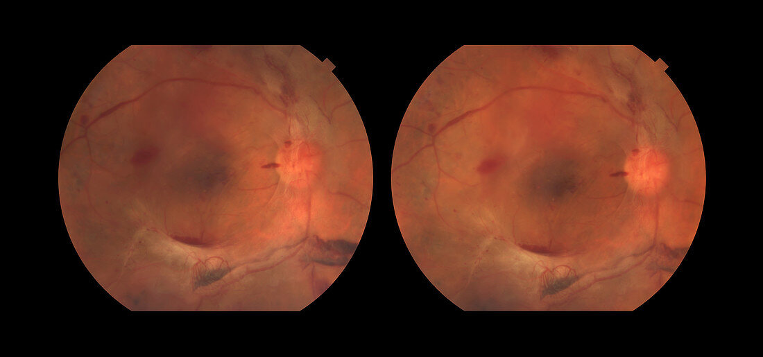 Proliferative Diabetic Retinopathy