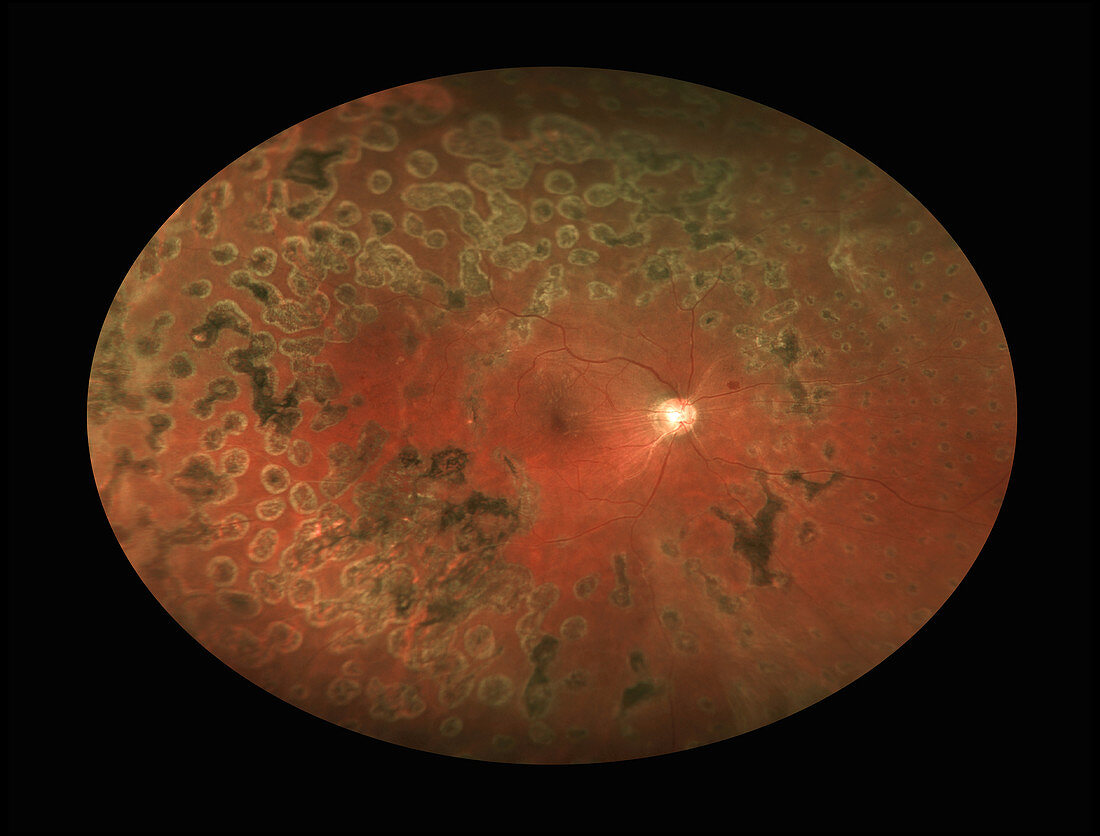 Pan retinal Photocoagulation Scars