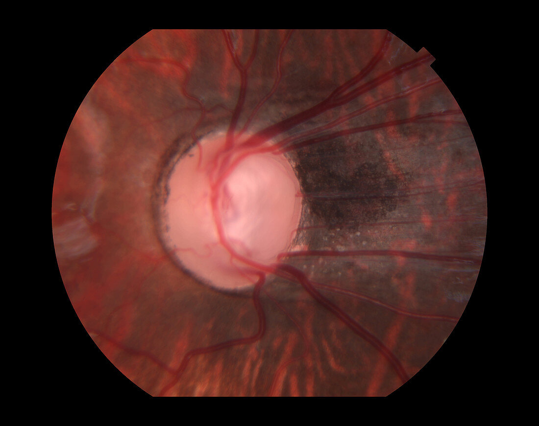 Macular Dragging