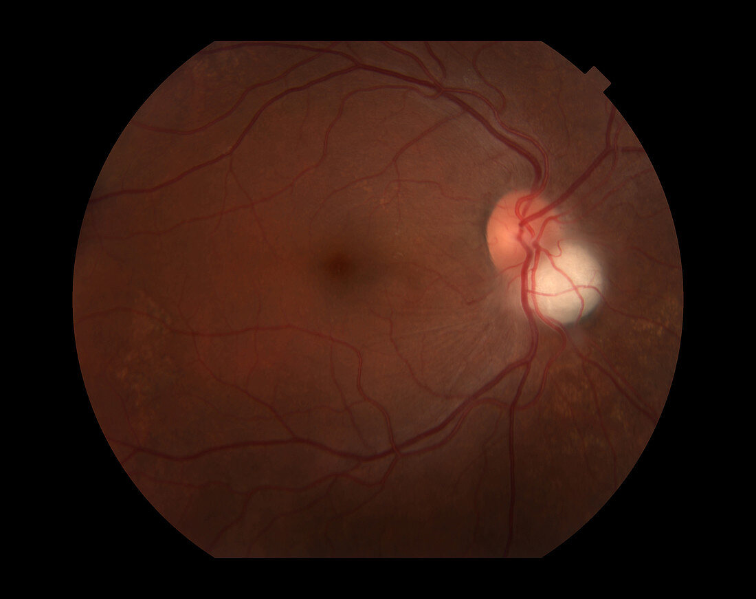 Astrocytic Hamartoma