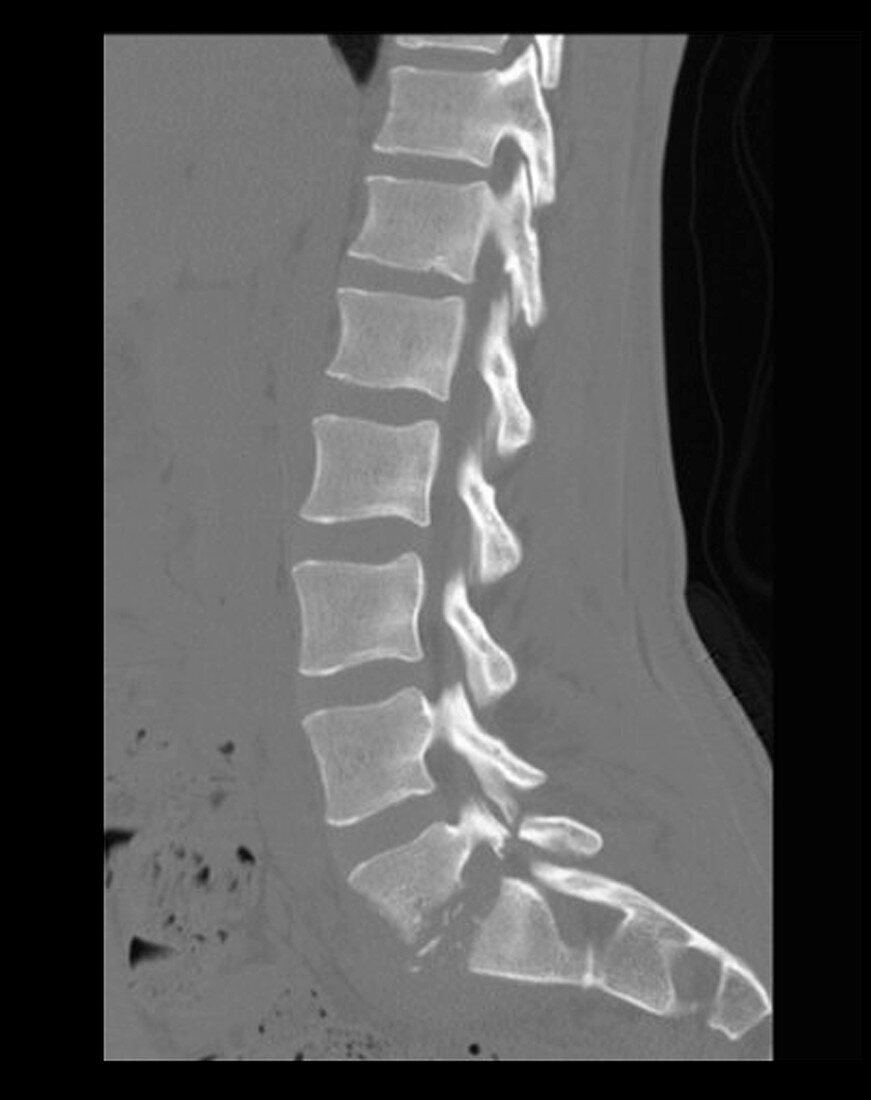 Discitis,CT Scan