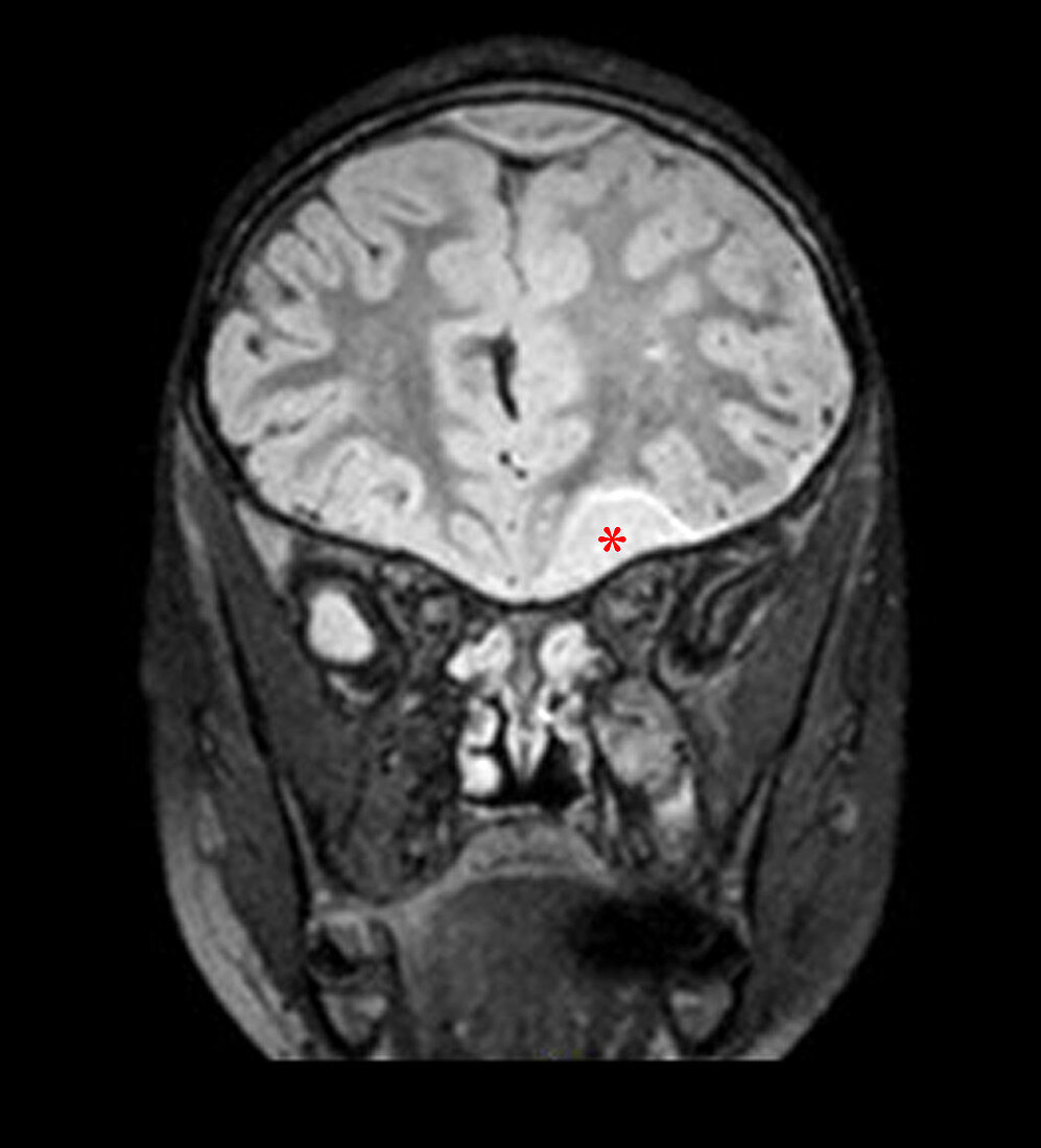 Sinusitis with Empyema,CT Scan