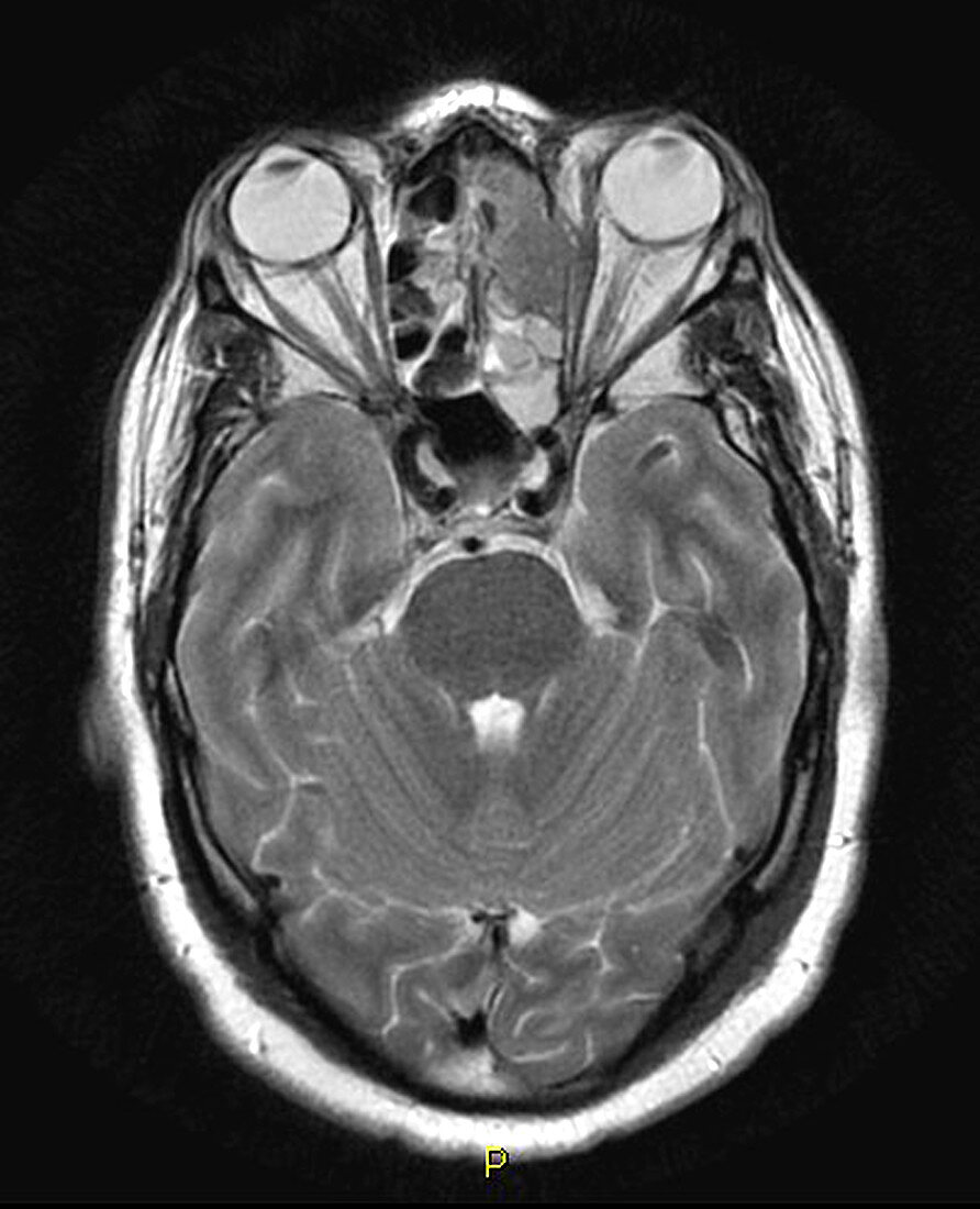Squamous Cell Cancer of Ethmoids,MRI