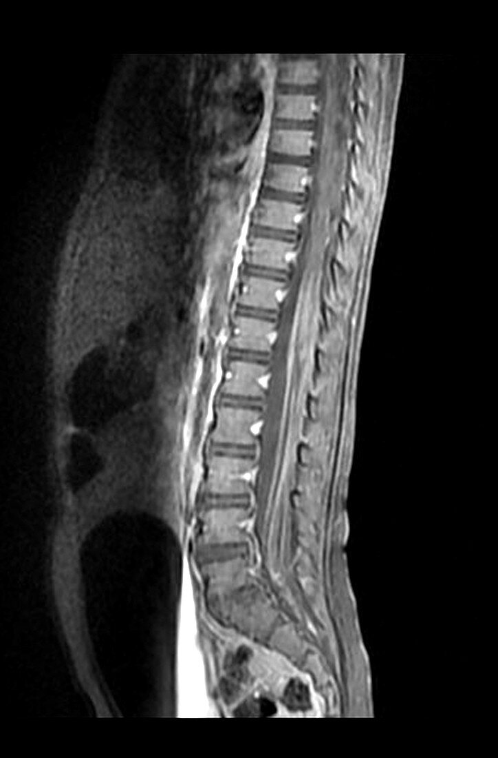 Chronic Demyelinating Polyneuropathy,MRI