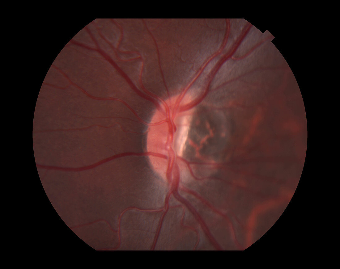 Congenital Tilted Disc Syndrome