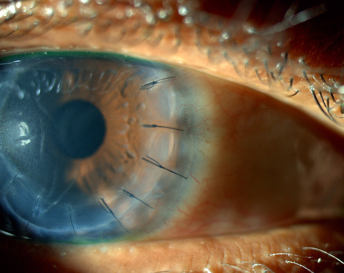 Corneal Transplant