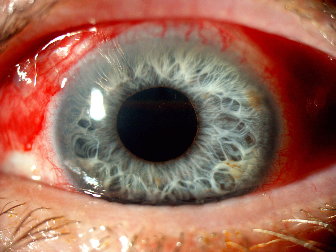 Conjunctivitis