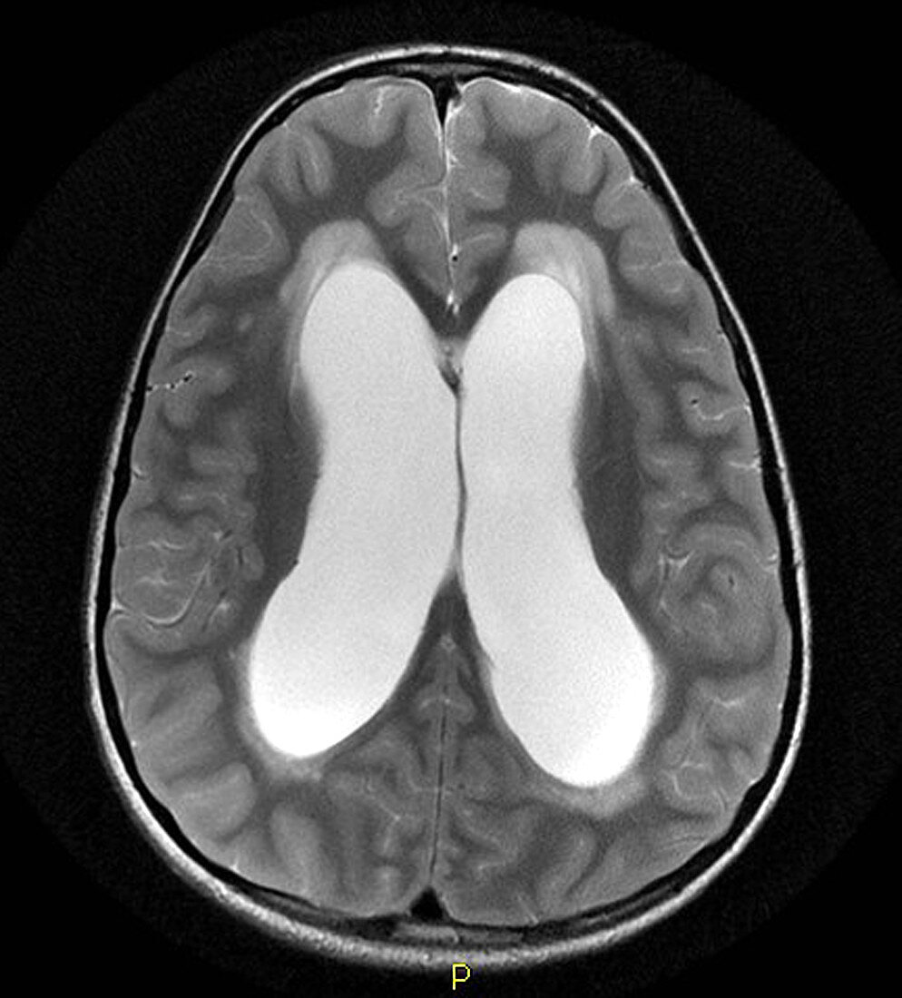 Medulloblastoma,MRI