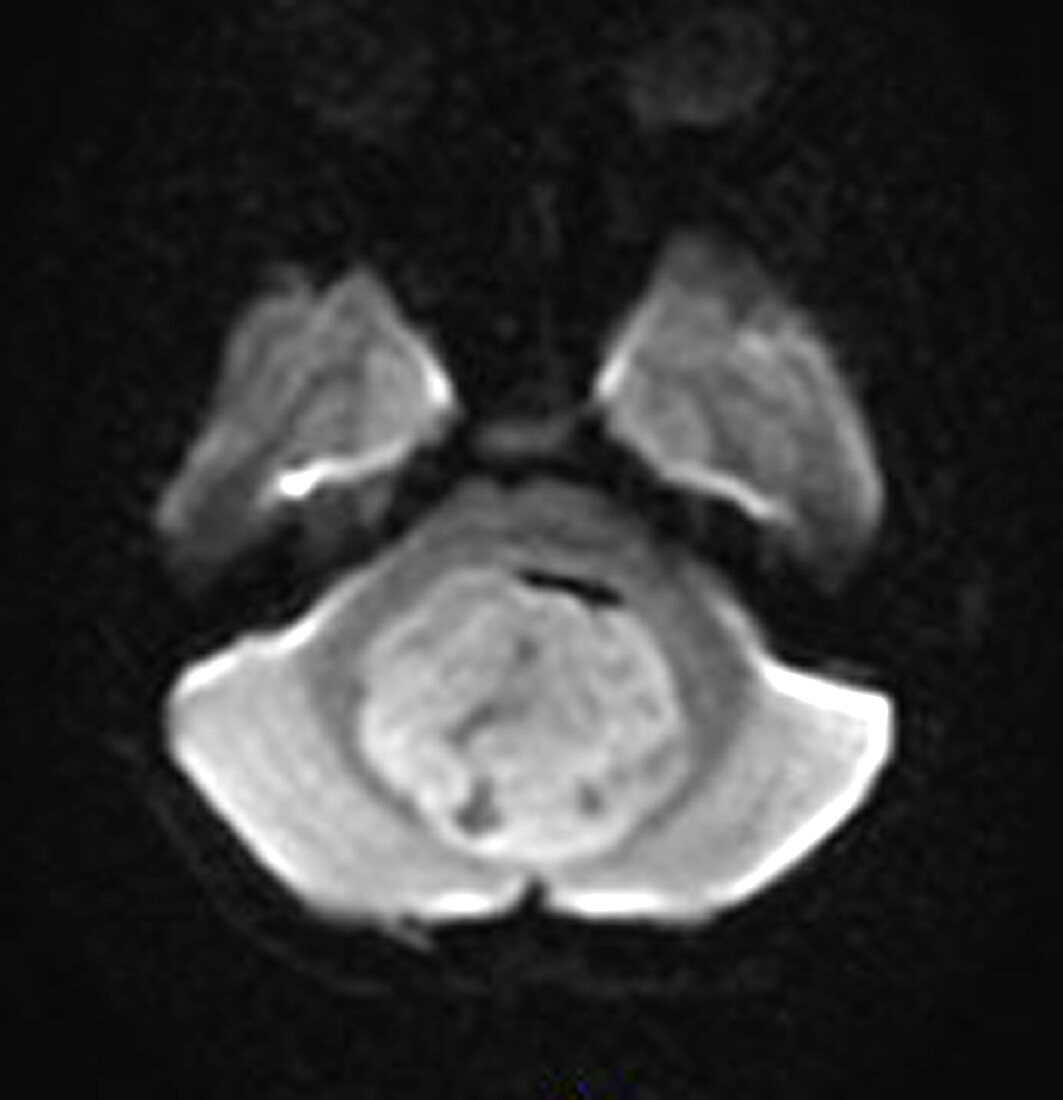 Medulloblastoma,MRI