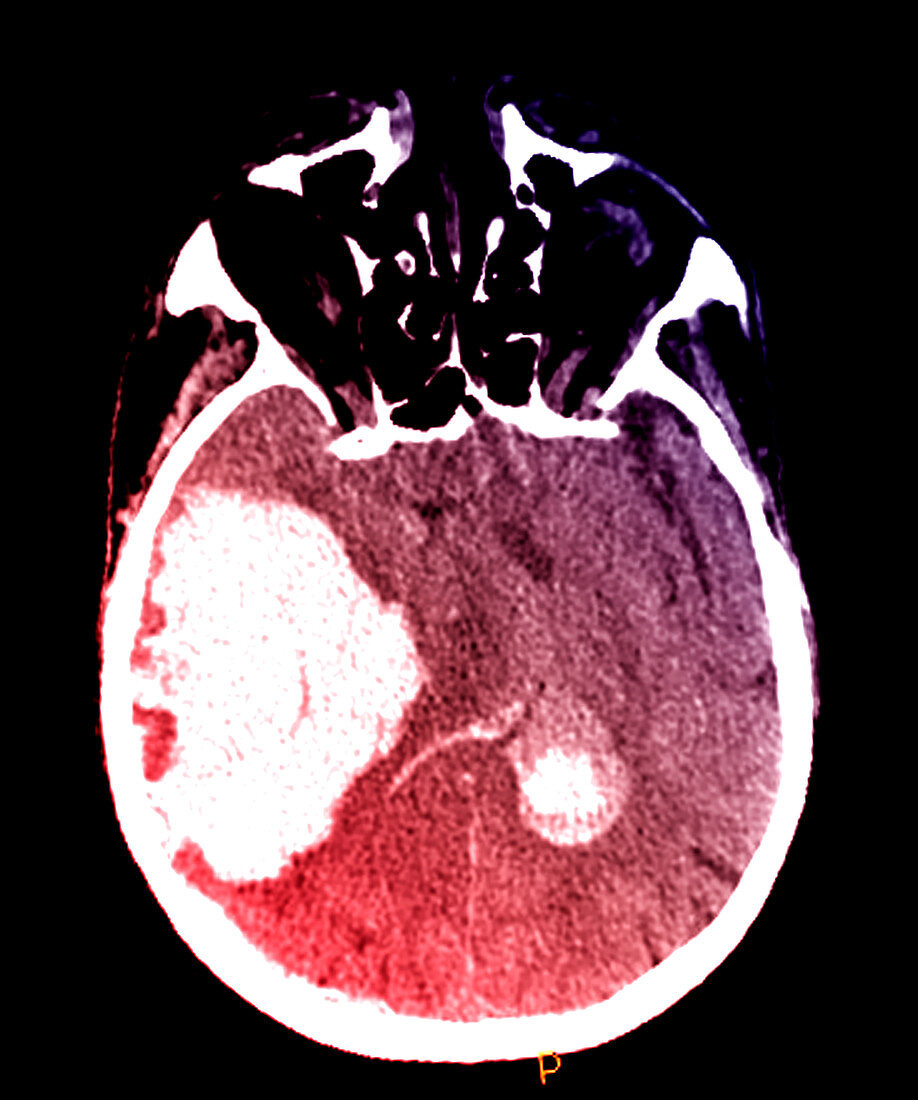 Massive Intracranial Hemorrhage,CT Scan