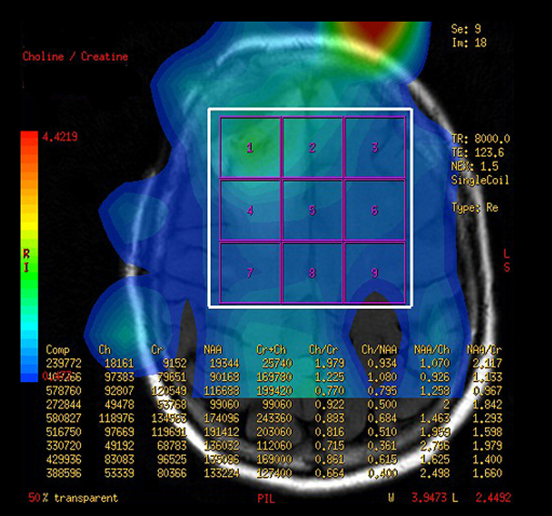 Post Operative MR Spectroscopy for GBM