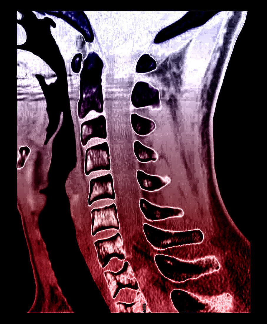 Sickle Cell Osteopathy,CT Scan