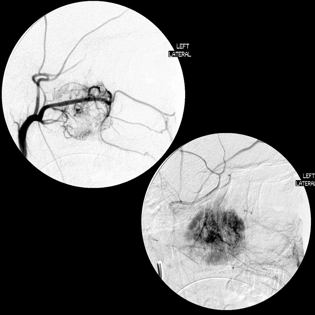 Nasopharyngeal Angiofibroma,CT Scan