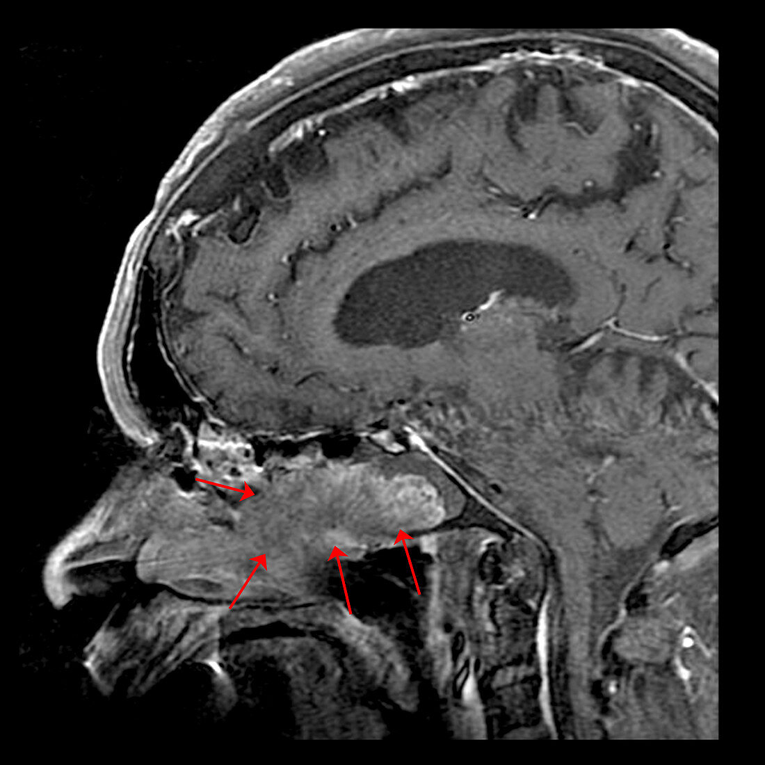 Inverted Papilloma,MRI