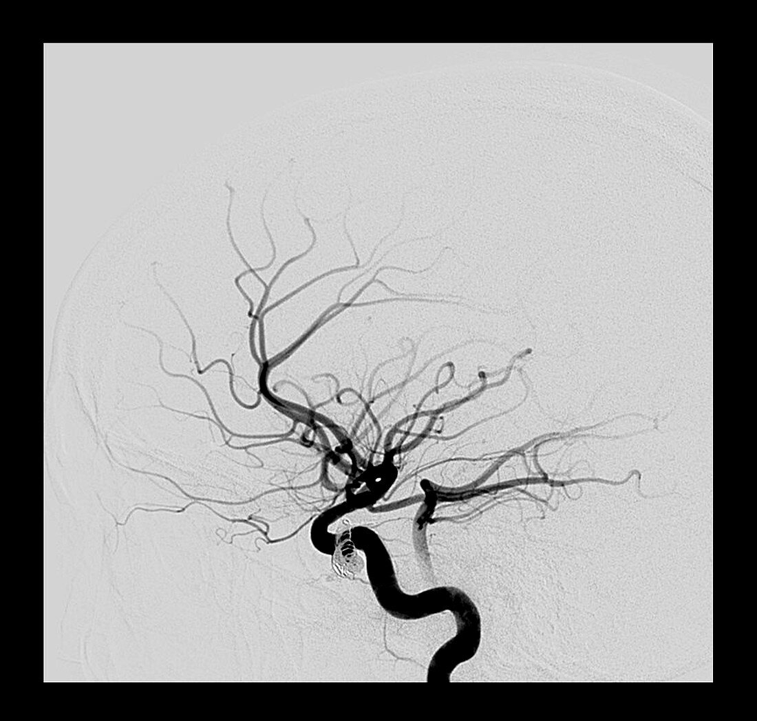 Carotid Cavernous Sinus Fistula,MRI