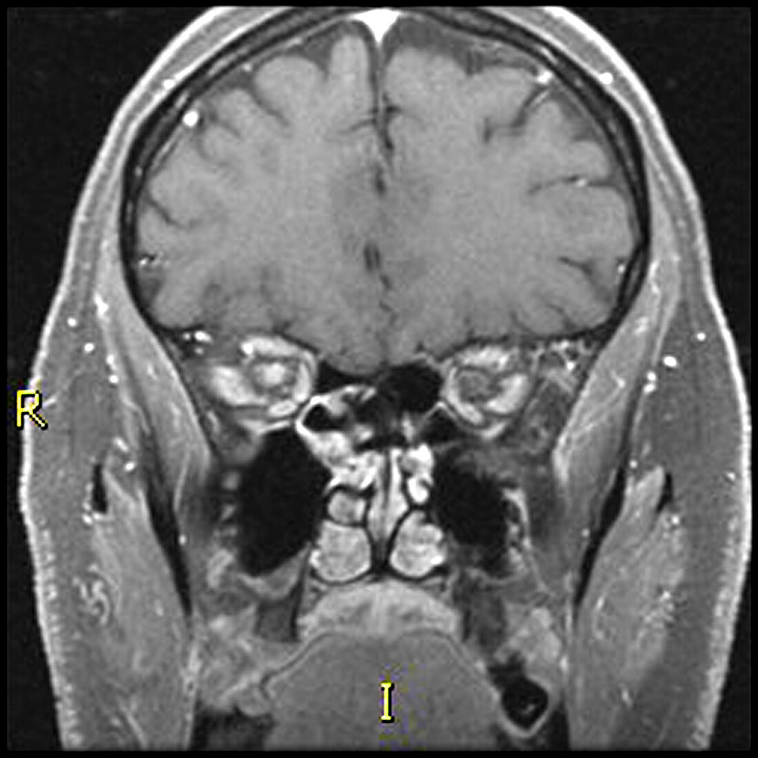 Optic Neuritis,MRI