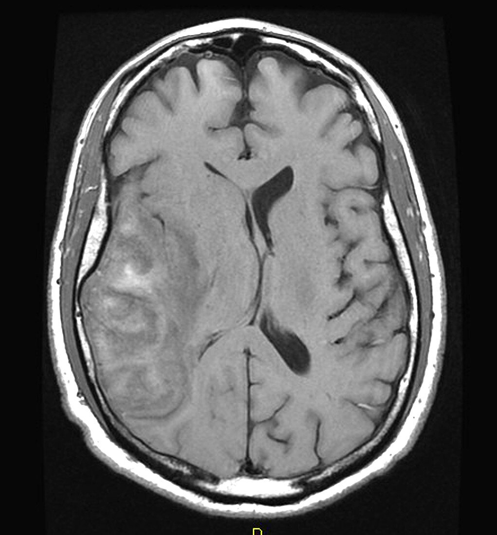 Haemorrhagic Cerebral Infarct,MRI