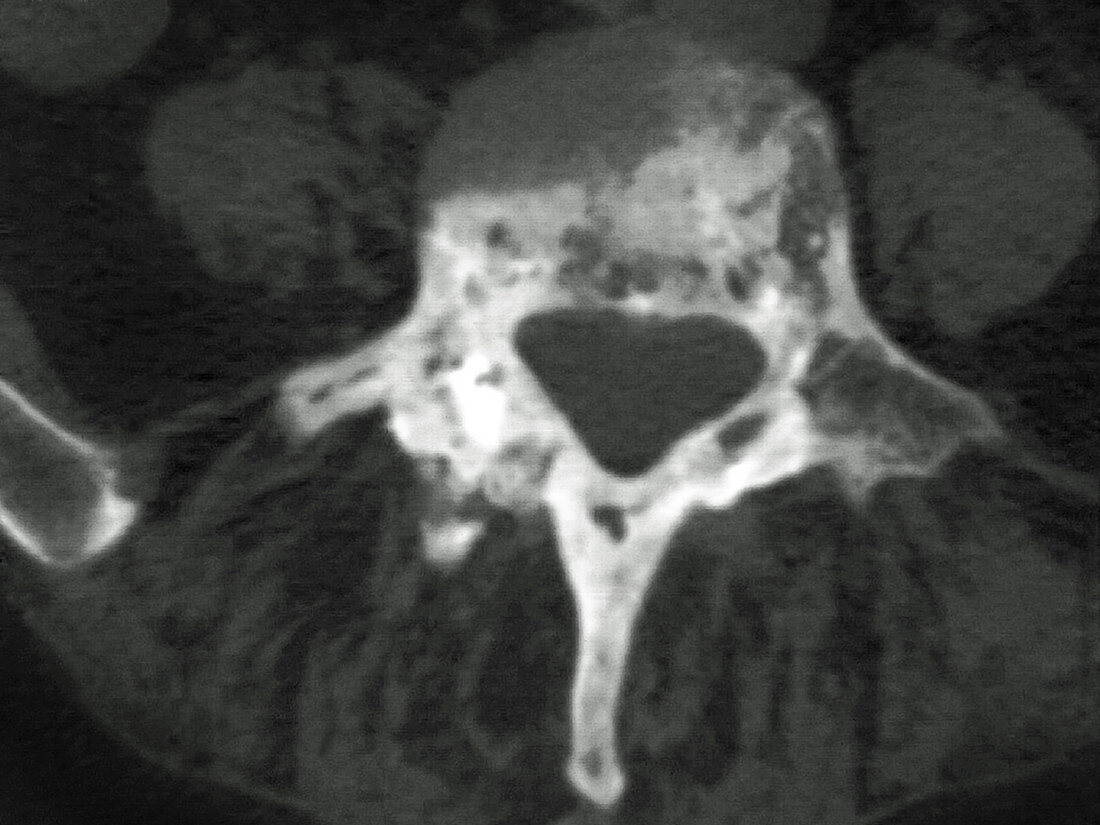 Pott's Disease,MRI