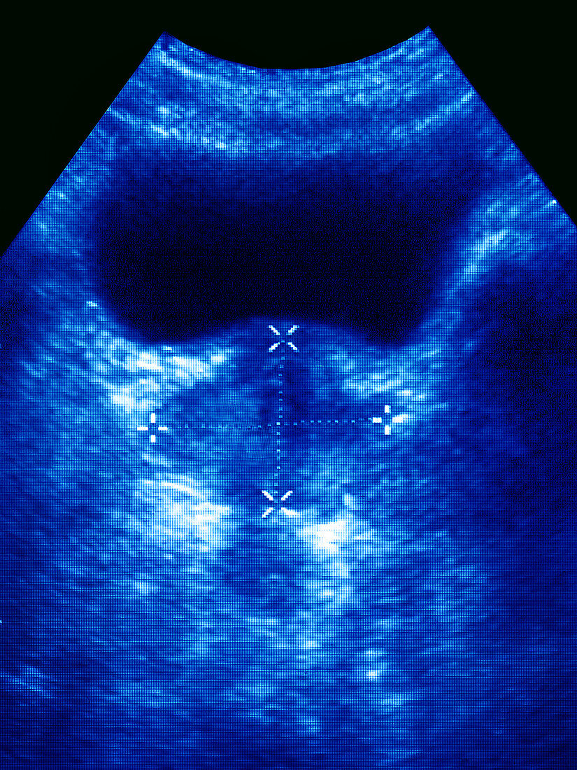 Prostate,Ultrasound