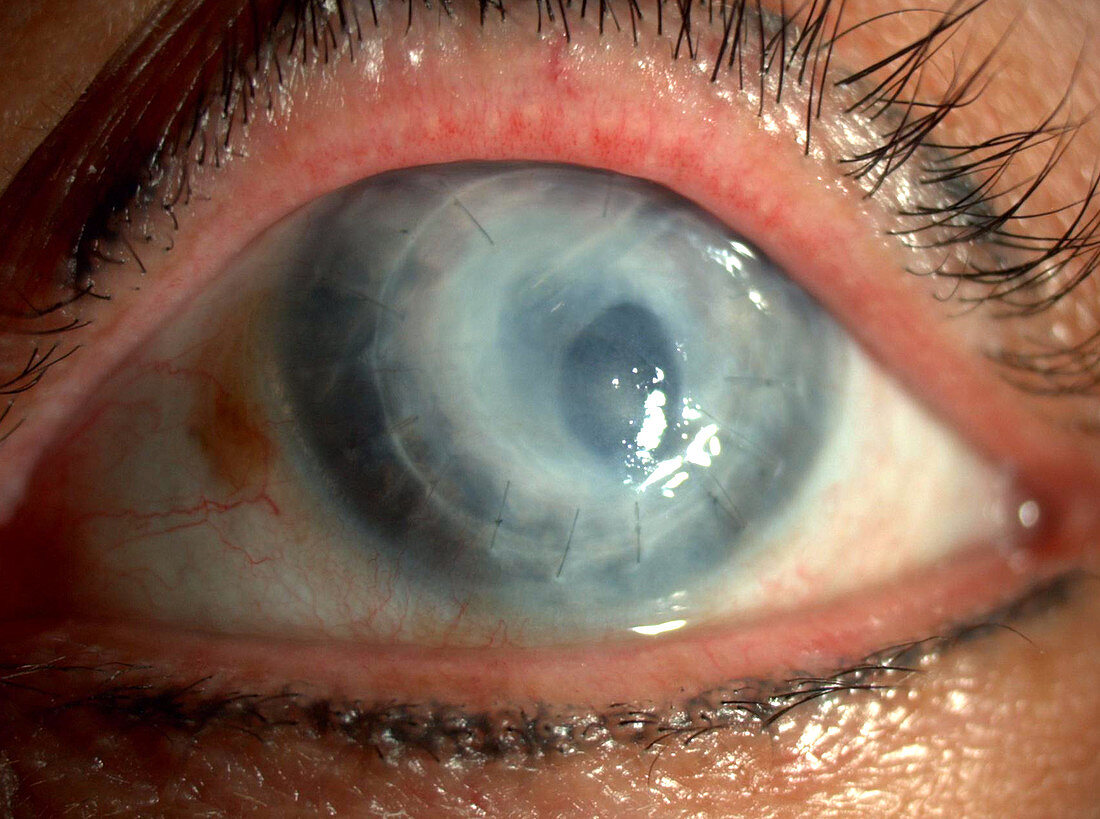 Rejected Corneal Graft