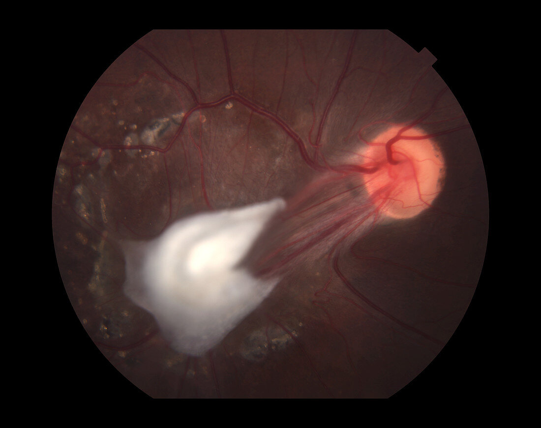 Scar and Macular Dragging