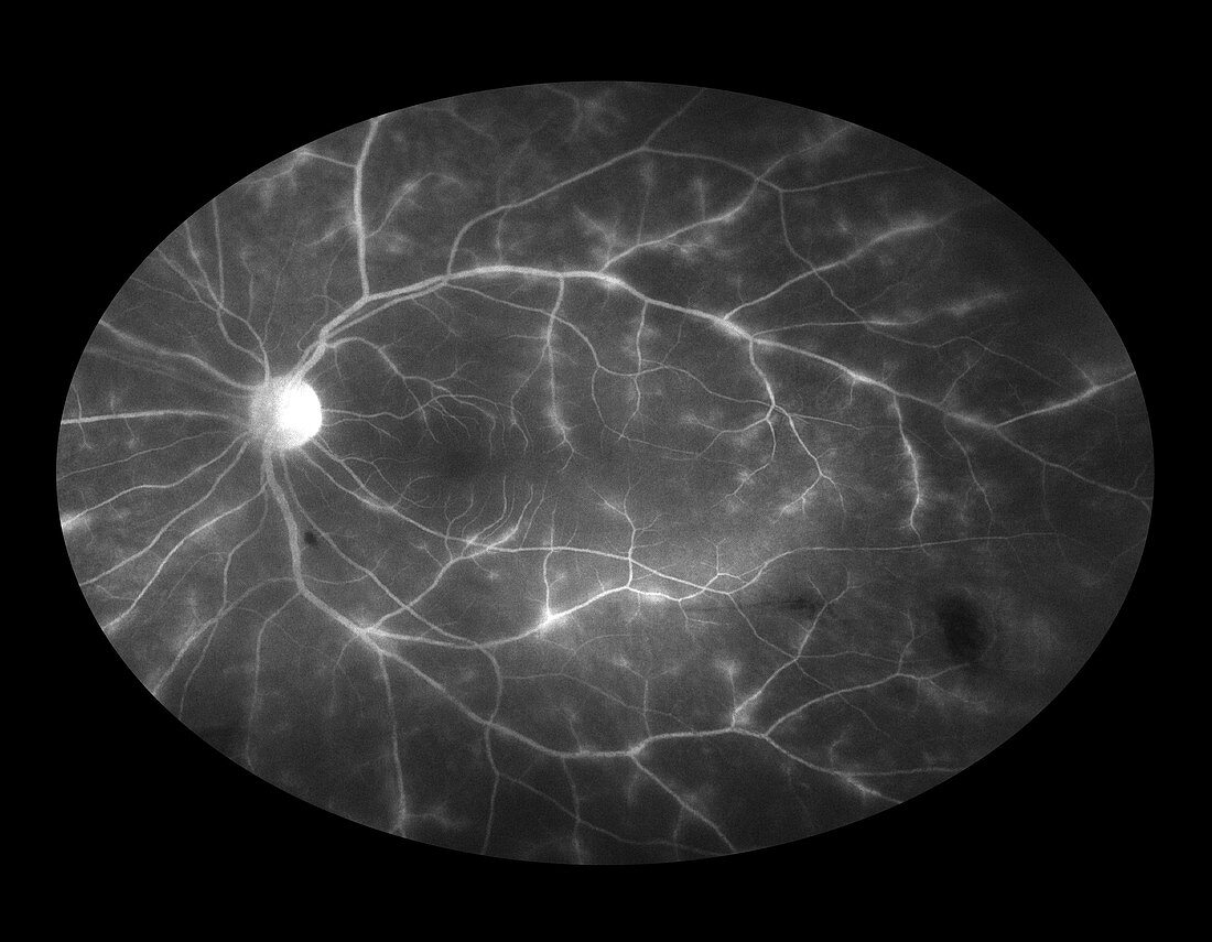 Retinal Vasculitis