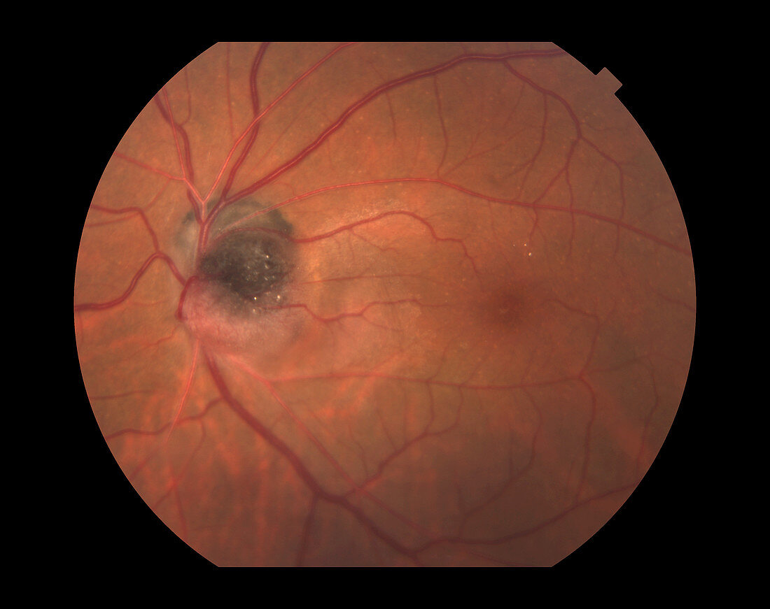 Melanocytoma