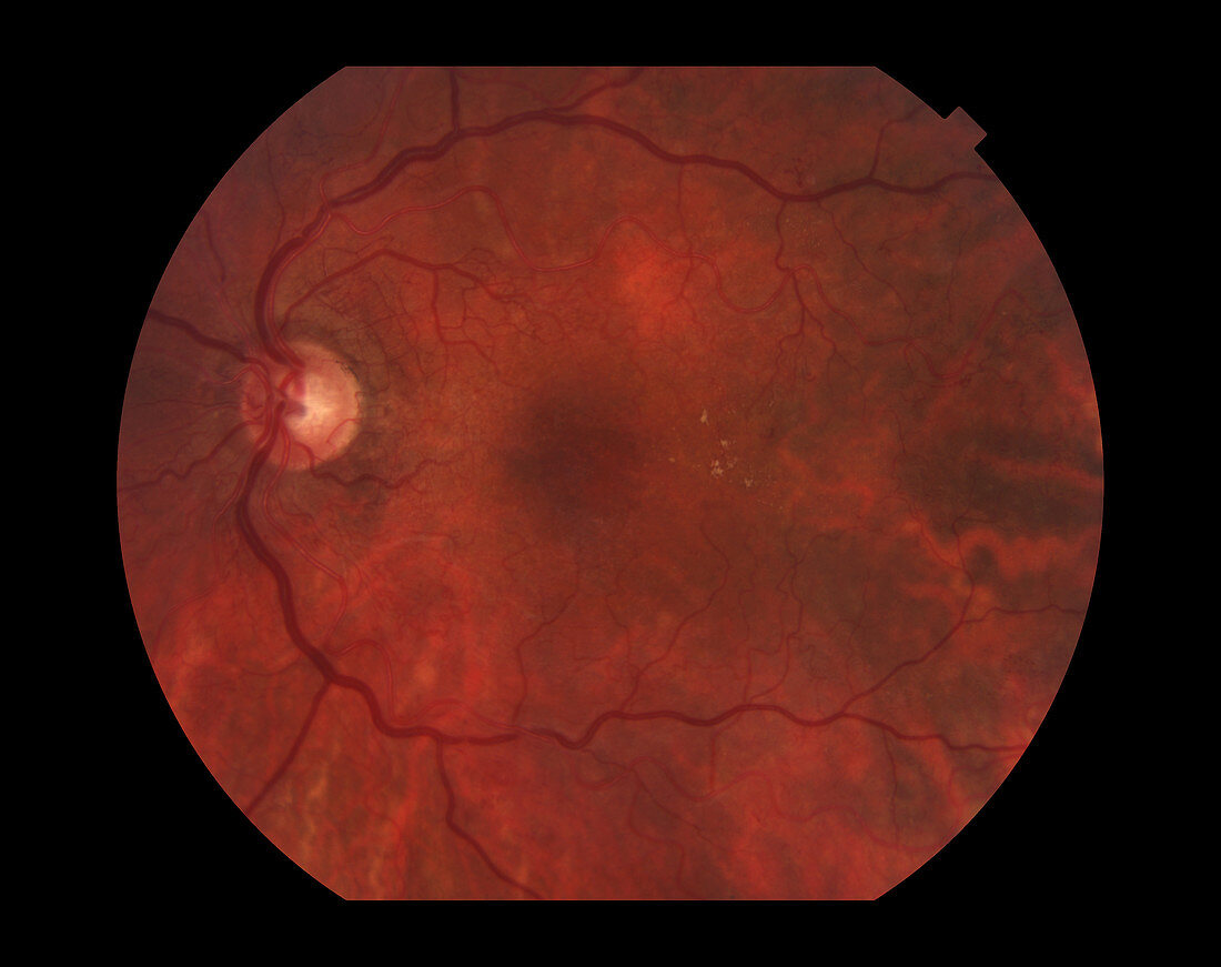 Old Vein Occlusion