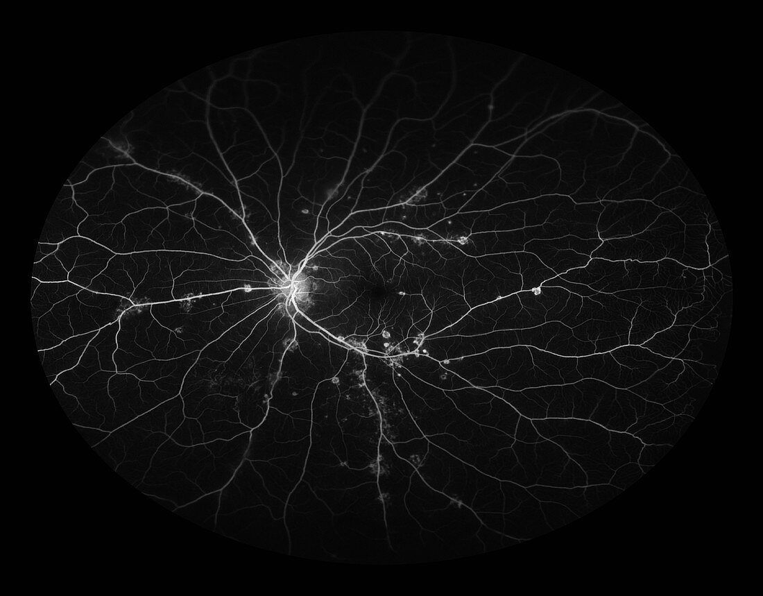 Retinal Vasculitis,Ophthalmic Medicine