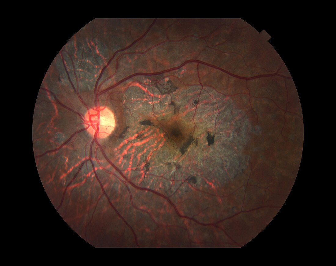 Macular Dystrophy,Ophthalmic Medicine