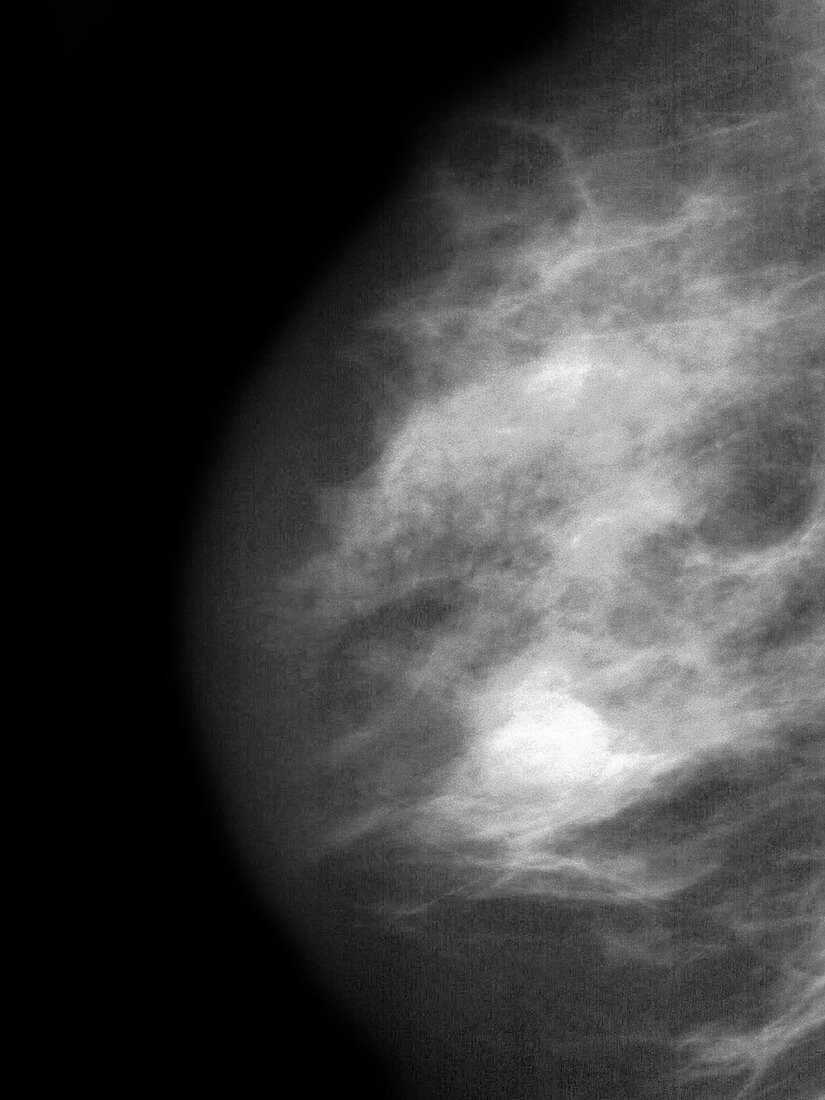 Breast Cancer,Mammogram